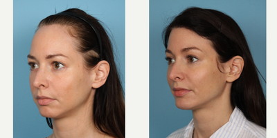 Brow Lift before and after photo