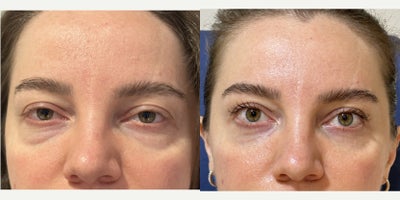 Double Eyelid Surgery before and after photo