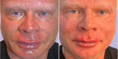 Lip Fillers before and after photo