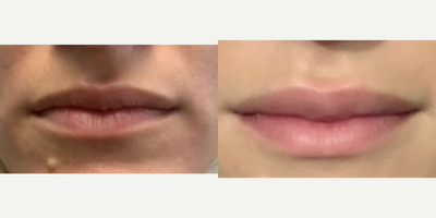 Restylane Kysse before and after photo