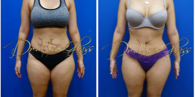 Tummy Tuck before and after photo