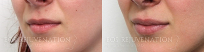 Lip Fillers before and after photo