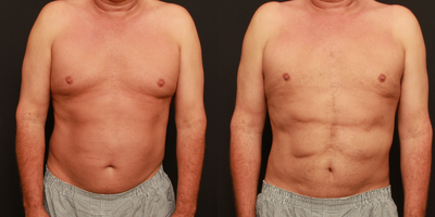Liposculpture before and after photo