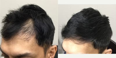 PRP for Hair Loss before and after photo