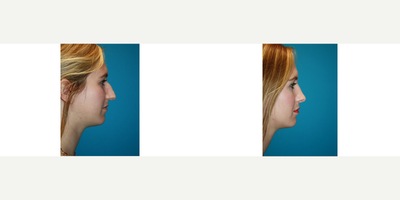 Rhinoplasty before and after photo
