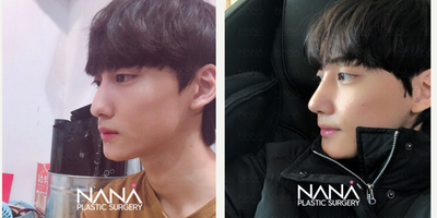 Rhinoplasty before and after photo