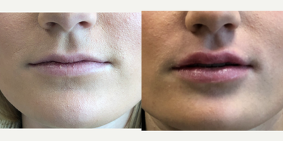 Volbella before and after photo