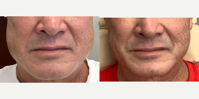 Botox for TMJ before and after photo