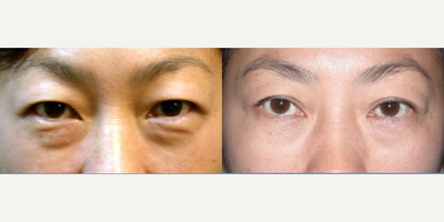 Double Eyelid Surgery before and after photo