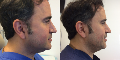 Kybella before and after photo