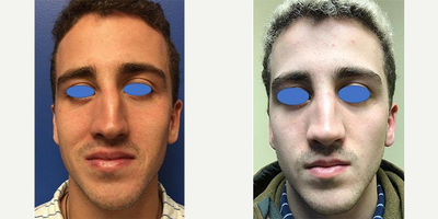 Rhinoplasty before and after photo
