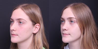 Rhinoplasty before and after photo
