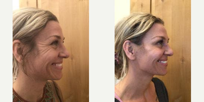 Botox before and after photo