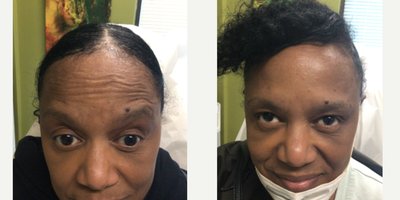 Botox before and after photo