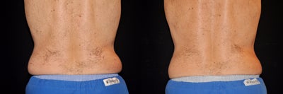 CoolSculpting before and after photo