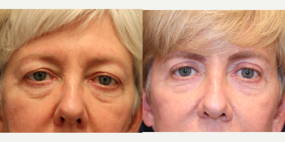 Eyelid Surgery before and after photo
