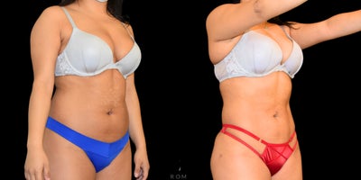 Liposuction before and after photo