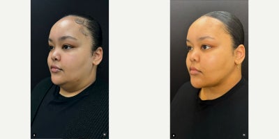 Renuvion before and after photo