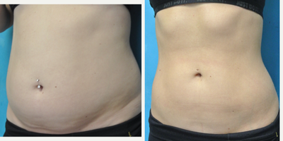 Vanquish before and after photo