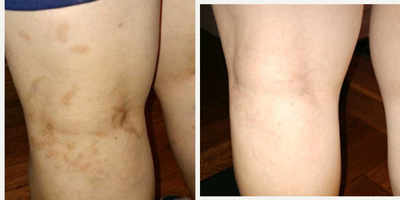 YAG Laser before and after photo