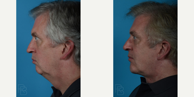 Facelift before and after photo