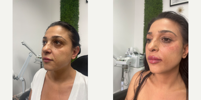 Lip Fillers before and after photo
