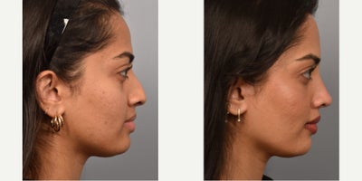Rhinoplasty before and after photo