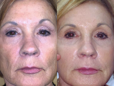 Sculptra before and after photo