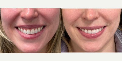 Botox for Gummy Smile before and after photo