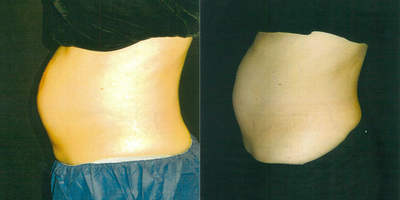 CoolSculpting before and after photo