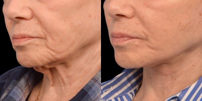Deep Plane Facelift before and after photo
