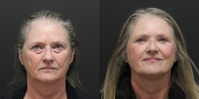 Eyelid Surgery before and after photo