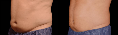 CoolSculpting before and after photo