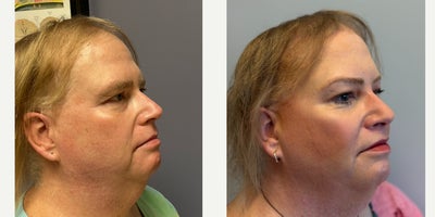 Facial Feminization Surgery before and after photo