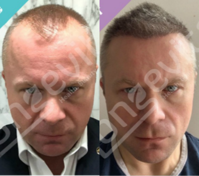 FUE Hair Transplant before and after photo