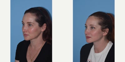 Lower Facelift before and after photo