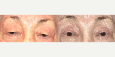 Ptosis Surgery before and after photo