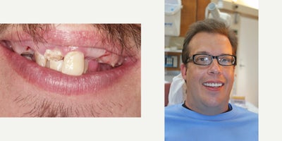 All-on-4 Dental Implants before and after photo