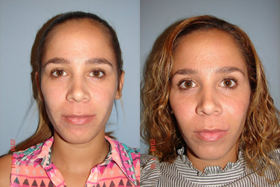 Cheek Augmentation before and after photo