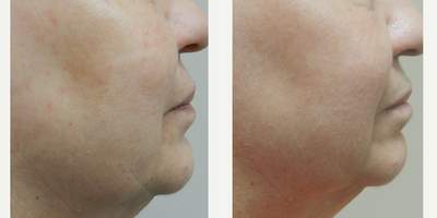 Halo Laser before and after photo