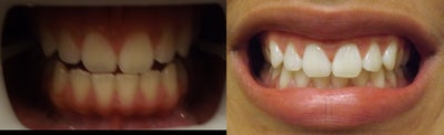 Teeth Whitening before and after photo