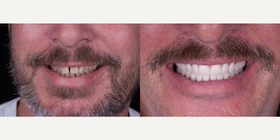 All-on-4 Dental Implants before and after photo