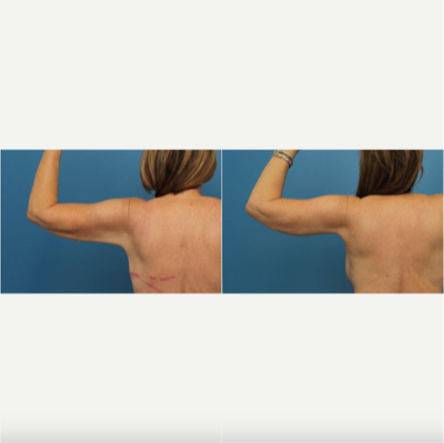 Arm Lift before and after photo