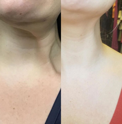 Botox before and after photo