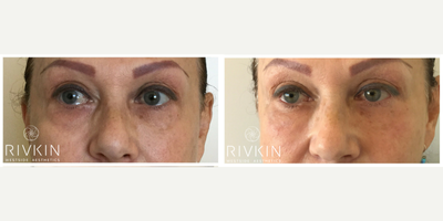 Eyelid Surgery before and after photo