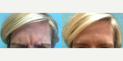 Botox before and after photo
