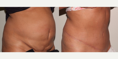 Tummy Tuck before and after photo