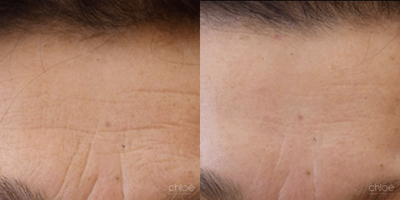 Botox before and after photo
