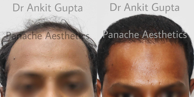 FUE Hair Transplant before and after photo
