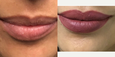 Restylane Refyne before and after photo